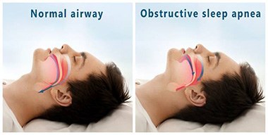 model of sleep apnea